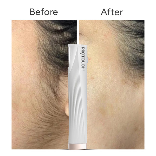 Protouch Derma Planning Device For Hair Removal | Protouch at Broadway