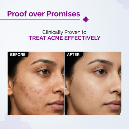 2% Salicylic Acid Serum for Active Acne - 10ml