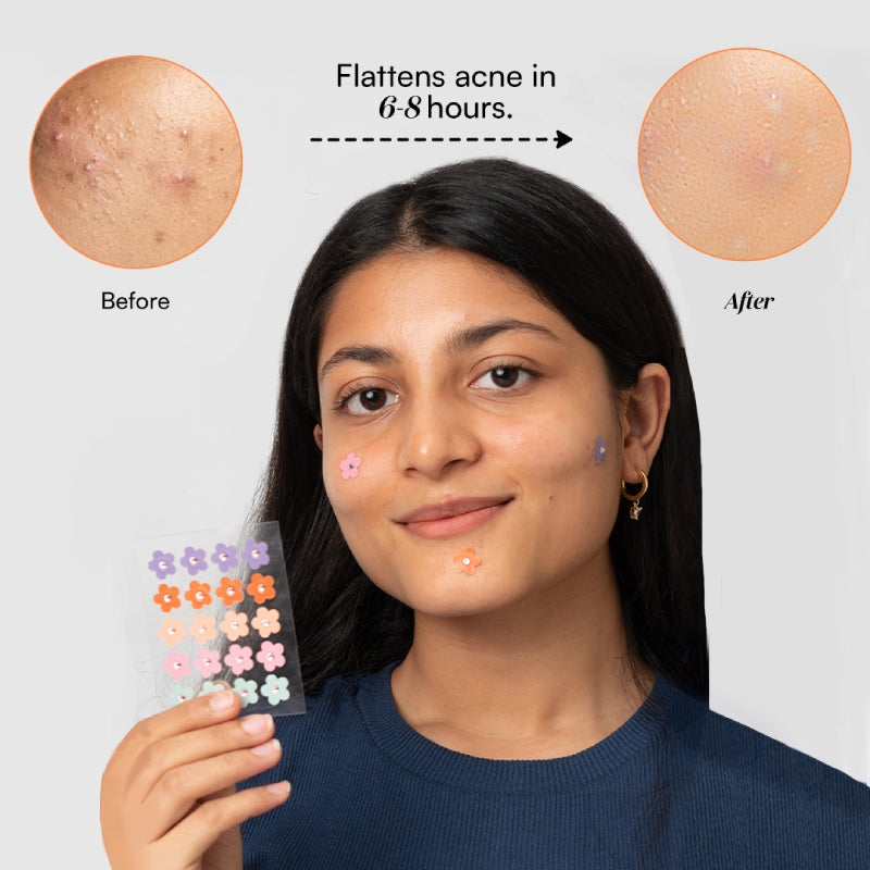 Dart It - Tea Tree & Hydrocolloid Acne Pimple Patches for Zits & Blemishes