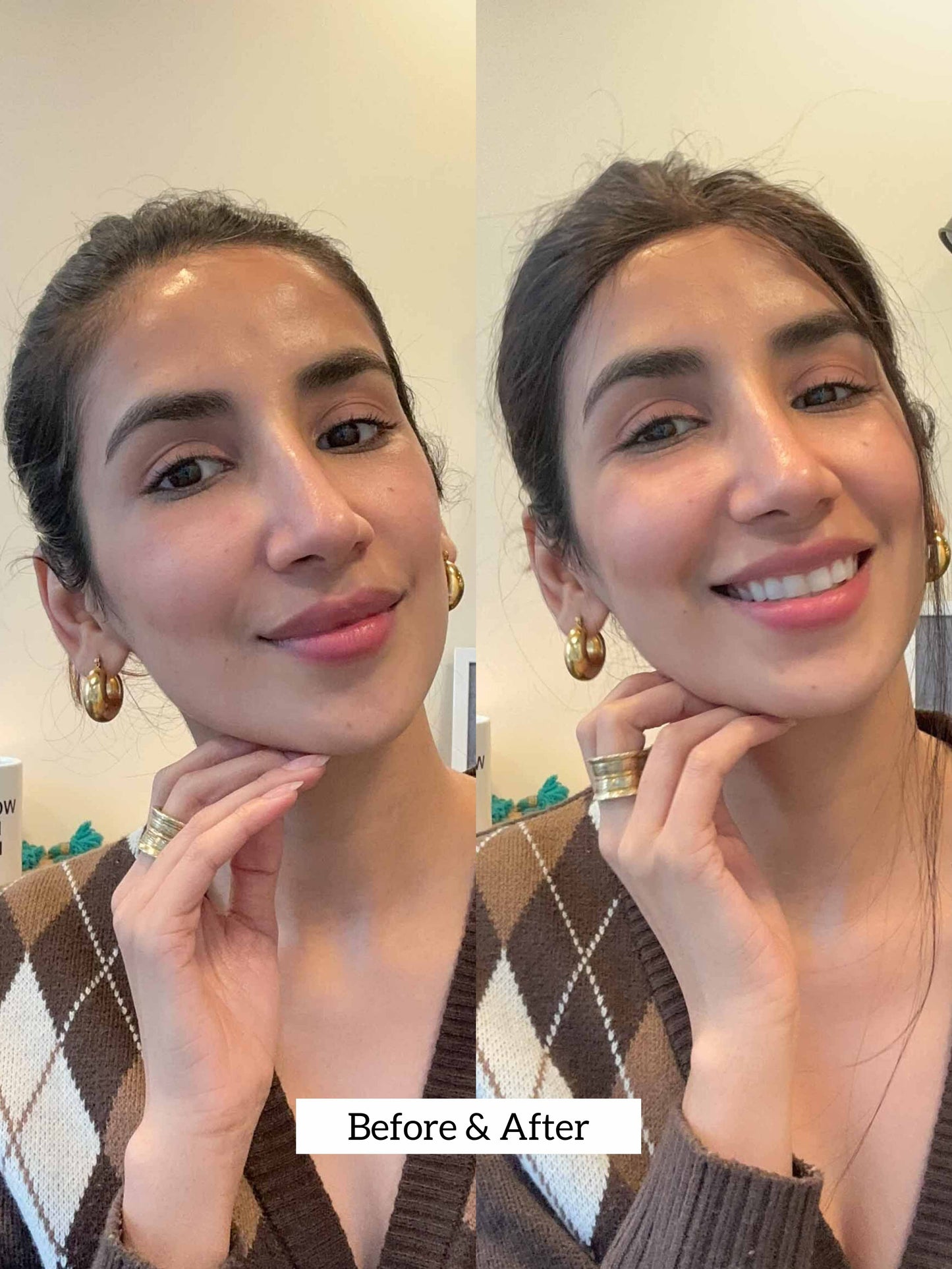 Bring Back My Hairline Patch | Nish Hair